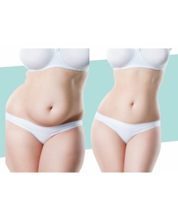 Cryolipolyse en 3 séances