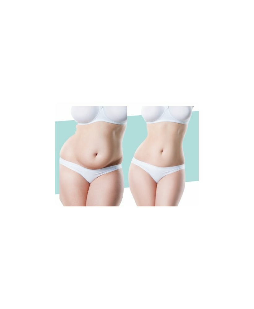 Cryolipolyse en 3 séances