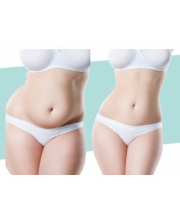 Cryolipolyse en 3 séances