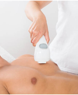 PhotoDépilation cuisses - épilation définitive